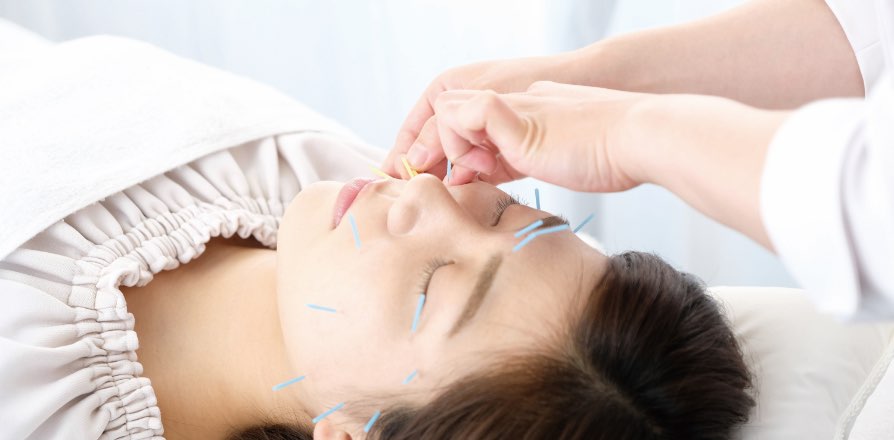 美容鍼